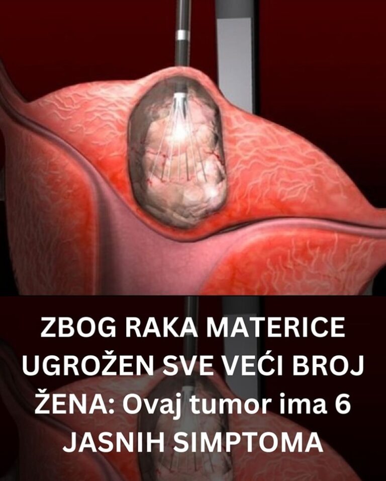 ZBOG RAKA MATERICE UGROŽEN SVE VEĆI BROJ ŽENA:  Ovaj tumor ima 6 JASNIH SIMPTOMA