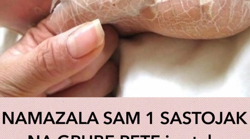 NAMAZALA SAM 1 SASTOJAK NA GRUBE PETE i ostala u šoku: Koža mi je mekana kao bebina, TRIK KOJI ME SPASIO RUŽNIH I ISPUCALIH PETA